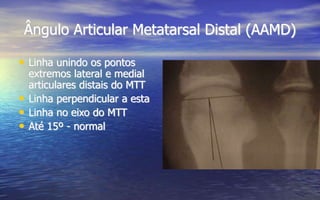 Ângulo Articular Metatarsal Distal (AAMD)
• Linha unindo os pontos
extremos lateral e medial
articulares distais do MTT
• Linha perpendicular a esta
• Linha no eixo do MTT
• Até 15º - normal
 