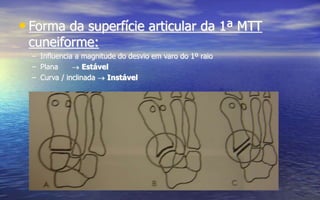 • Forma da superfície articular da 1ª MTT
cuneiforme:
– Influencia a magnitude do desvio em varo do 1º raio
– Plana  Estável
– Curva / inclinada  Instável
 