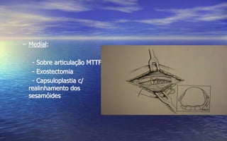 – Medial:
- Sobre articulação MTTF,
- Exostectomia
- Capsuloplastia c/
realinhamento dos
sesamóides
 