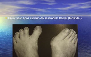 • Hálux varo após excisão do sesamóide lateral (McBride )
 