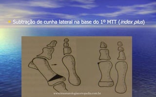 • Subtração de cunha lateral na base do 1º MTT (index plus)
www.traumatologiaeortopedia.com.br
 