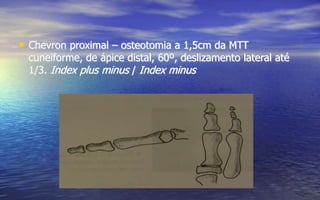 • Chevron proximal – osteotomia a 1,5cm da MTT
cuneiforme, de ápice distal, 60º, deslizamento lateral até
1/3. Index plus minus / Index minus
 