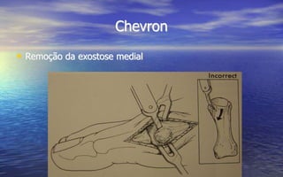 Chevron
• Remoção da exostose medial
 