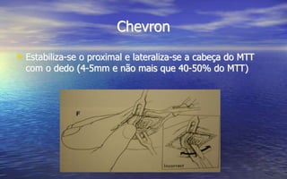 Chevron
• Estabiliza-se o proximal e lateraliza-se a cabeça do MTT
com o dedo (4-5mm e não mais que 40-50% do MTT)
 