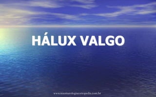 HÁLUX VALGO
www.traumatologiaeortopedia.com.br
 