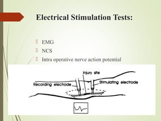 Electrical Stimulation Tests:
 EMG
 NCS
 Intra operative nerve action potential
 