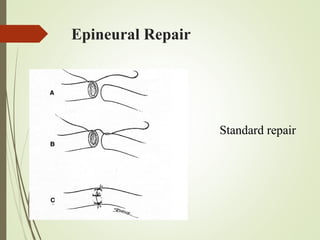Epineural Repair
Standard repair
 