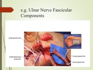 e.g. Ulnar Nerve Fascicular
Components
 