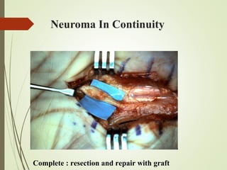 Neuroma In Continuity
Complete : resection and repair with graft
 