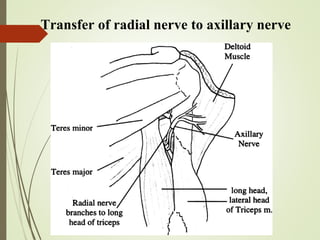 Transfer of radial nerve to axillary nerve
 
