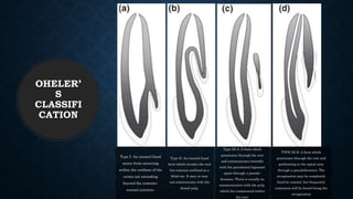 Type I: An enamel-lined
minor form occurring
within the confines of the
crown not extending
beyond the cemento-
enamel junction.
Type II: An enamel-lined
form which invades the root
but remains confined as a
blind sac. It may or may
not communicate with the
dental pulp.
Type III A: A form which
penetrates through the root
and communicates laterally
with the periodontal ligament
space through a pseudo-
foramen. There is usually no
communication with the pulp,
which lies compressed within
the root.
TYPE III B: A form which
penetrates through the root and
perforating at the apical area
through a pseudoforamen. The
invagination may be completely
lined by enamel, but frequently
cementum will be found lining the
invagination
OHELER’
S
CLASSIFI
CATION
 