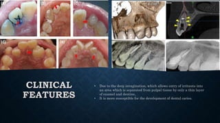 CLINICAL
FEATURES
• Due to the deep invagination, which allows entry of irritants into
an area which is separated from pulpal tissue by only a thin layer
of enamel and dentine,
• It is more susceptible for the development of dental caries.
 