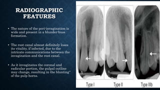 RADIOGRAPHIC
FEATURES
• The nature of the peri-invagination is
wide and present in a blunder-buss
formation.
• The root canal almost definitely loses
its vitality, if infected, due to the
intricate communications between the
invagination and the root canal.
• As it invaginates the coronal and
radicular portion, the pulpal outline
may change, resulting in the blunting‟
of the pulp horns.
 