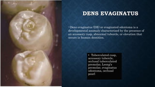 DENS EVAGINATUS
• Tuberculated cusp,
accessory tubercle,
occlusal tuberculated
premolar, Leong's
premolar, evaginatus
odontoma, occlusal
pearl
•Dens evaginatus (DE) or evaginated odontoma is a
developmental anomaly characterized by the presence of
an accessory cusp, abnormal tubercle, or elevation that
occurs in human dentition.
 
