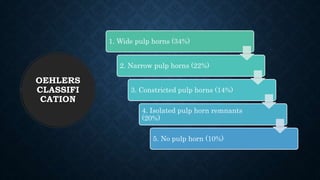 OEHLERS
CLASSIFI
CATION
1. Wide pulp horns (34%)
2. Narrow pulp horns (22%)
3. Constricted pulp horns (14%)
4. Isolated pulp horn remnants
(20%)
5. No pulp horn (10%)
 