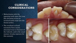 CLINICAL
CONSIDERATIONS
• Malocclusion with the
opposing tooth upon the cusp-
like elevation occurs as
involved teeth erupt into the
dental arches.
• The resultant occlusal
traumatic force causes
abnormal wear or fracture of
the tubercle, and is the usual
manner of pulp exposure for
this anomaly
 