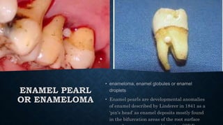 ENAMEL PEARL
OR ENAMELOMA
 