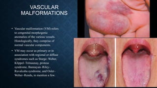 VASCULAR
MALFORMATIONS
• Vascular malformation (VM) refers
to congenital morphogenic
anomalies of the various vessels.
Histologically, they comprise of
normal vascular components.
• VM may occur as primary or in
association with regional or diffuse
syndromes such as Sturge–Weber,
Klippel–Trénaunay, proteus
syndrome, Bannayan–Riley–
Ruvalcaba syndrome, and Osler–
Weber–Rendu, to mention a few.
 