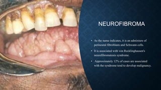 NEUROFIBROMA
• As the name indicates, it is an admixture of
perineural fibroblasts and Schwann cells.
• It is associated with von Recklinghausen's
neurofibromatosis syndrome.
• Approximately 12% of cases are associated
with the syndrome tend to develop malignancy.
 