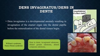 DENS INVAGINATUS/DENS IN
DENTE
• Dens invaginatus is a developmental anomaly resulting in
invagination of the enamel organ into the dental papilla
before the mineralization of the dental tissues begin.
Dens in dente, invaginated odontome,
dilated gestant odontoma, dilated
composite odontome,
William's syndrome,
Nance-Huran syndrome
 