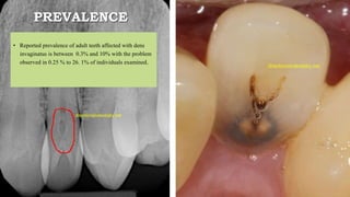 PREVALENCE
• Reported prevalence of adult teeth affected with dens
invaginatus is between 0.3% and 10% with the problem
observed in 0.25 % to 26. 1% of individuals examined.
 