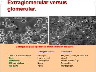 Extraglomerular versus
glomerular.
 