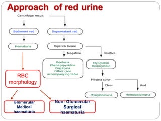 Approach of red urine
RBC
morphology
Non- Glomerular
Surgical
haematuria
Glomerular
Medical
haematuria
 