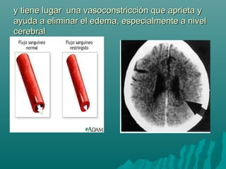 y tiene lugar una vasoconstricción que aprieta yy tiene lugar una vasoconstricción que aprieta y
ayuda a eliminar el edema, especialmente a nivelayuda a eliminar el edema, especialmente a nivel
cerebralcerebral
 