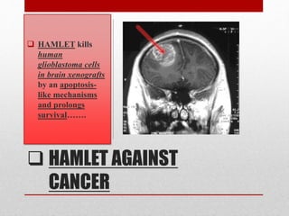  HAMLET AGAINST
CANCER
 HAMLET kills
human
glioblastoma cells
in brain xenografts
by an apoptosis-
like mechanisms
and prolongs
survival…….
 