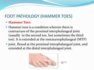 FOOT PATHOLOGY (HAMMER TOES)
 Hammer Toes
 Hammer toes is a condition wherein there is
contracture of the proximal interphalangeal joint
(usually in the second toe, but sometimes the third
toe). It is extended at the metatarsophalangeal (MTP)
 joint, flexed at the proximal interphalangeal joint, and
extended at the distal interphalangeal joint.
 