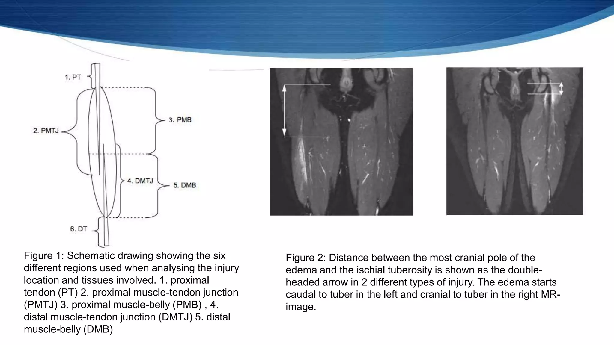 Figure 1: Schematic drawing showing the six
different regions used when analysing the injury
location and tissues involved. 1. proximal
tendon (PT) 2. proximal muscle-tendon junction
(PMTJ) 3. proximal muscle-belly (PMB) , 4.
distal muscle-tendon junction (DMTJ) 5. distal
muscle-belly (DMB)
Figure 2: Distance between the most cranial pole of the
edema and the ischial tuberosity is shown as the double-
headed arrow in 2 different types of injury. The edema starts
caudal to tuber in the left and cranial to tuber in the right MR-
image.
 