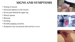 SIGNS AND SYMPTOMS
• Tearing of muscle
• Increased tightness in the muscle.
• Severe pain behind the upper leg
• Muscle spasms
• Bruising
• Swelling
• Possible popping sensation.
• Symptoms may not present until activity is over.
 