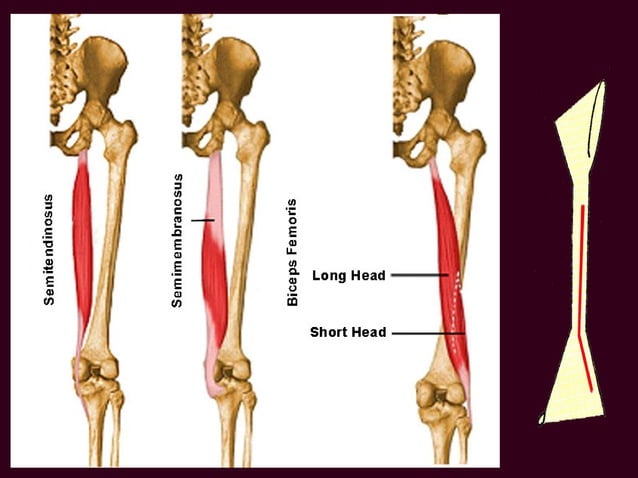 Entrapment Of The Proximal Sciatic Nerve By The Hamstring Tendons – BVBKM
