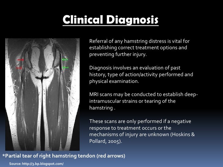 Hamstring strain pp