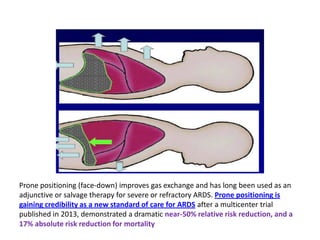 ARDS management | PDF