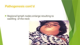 Pathogenesis cont’d
 Regional lymph nodes enlarge resulting to
swelling of the neck
 