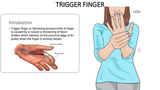 TRIGGER FINGER
 