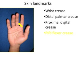 Skin landmarks
•Wrist crease
•Distal palmar crease
•Proximal digital
crease
•PIPJ flexor crease
 