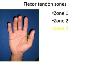 Flexor tendon zones
•Zone 1
•Zone 2
•Zone 3
 