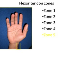 Flexor tendon zones
•Zone 1
•Zone 2
•Zone 3
•Zone 4
•Zone 5
 