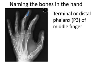 Naming the bones in the hand
Terminal or distal
phalanx (P3) of
middle finger
 
