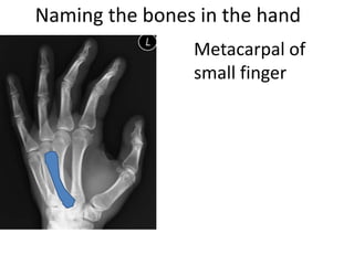 Naming the bones in the hand
Metacarpal of
small finger
 