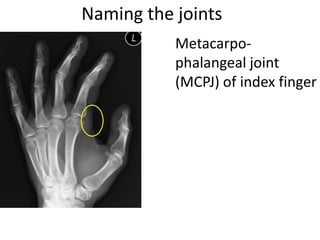 Naming the joints
Metacarpo-
phalangeal joint
(MCPJ) of index finger
 