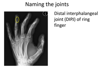 Naming the joints
Distal interphalangeal
joint (DIPJ) of ring
finger
 