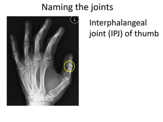 Naming the joints
Interphalangeal
joint (IPJ) of thumb
 