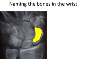 Naming the bones in the wrist
 