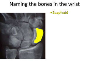 Naming the bones in the wrist
• Scaphoid
 