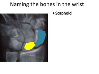 Naming the bones in the wrist
• Scaphoid
 