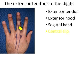 The extensor tendons in the digits
• Extensor tendon
• Extensor hood
• Sagittal band
• Central slip
 