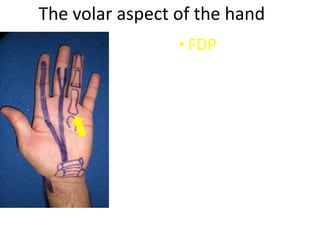 The volar aspect of the hand
• FDP
 